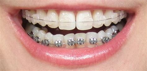 ceramic brackets vs metal|ceramic braces top metal bottom.